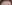 額リフト（前額リフト） — DM美容外科クリニック