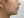 ยกกระชับ V-shape ด้วย HIFU (Shurink / Ultraformer III) — หลังทำ (30วัน) · Monster Clinic