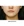 Volnewmer (โวลนิวเมอร์ ยกกระชับด้วย RF) — หลังทำ (30วัน) · คลินิกศัลยกรรมตกแต่งนาบี