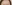 額縮小術（生え際下げ・ヘアライン下降術） — バタン美容外科クリニック