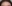 額縮小術（生え際下げ・ヘアライン下降術） — ララ美容外科クリニック