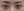 incisional double eyelid surgery — before (7days) · iLumi Plastic Surgery Clinic