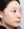 太阳穴自体脂肪填充 — 术前 (28天) · Lively医美诊所