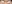 裏ハムラ法（経結膜的眼窩脂肪移動術） — プレジャー美容外科クリニック