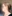 額縮小術（生え際下げ・ヘアライン下降術） — ザフィックス美容外科クリニック