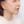 下巴異物取出（下巴假體移除） — 術後 (60天) · Returning醫美診所