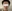Mini facelift (short-scar, limited-incision facelift) — Wonjin Plastic Surgery Clinic