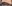 涙袋ヒアルロン酸注入（涙袋形成） — A-Top美容外科クリニック