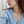 สลายไขมันใบหน้าด้วยเลเซอร์ (AccuSculpt) — หลังทำ (3วัน) · เออร์เน่คลินิก