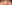 鼻尖形成術（自家軟骨移植） — タンキュー美容外科クリニック
