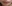 人中短縮（リップリフト） — ベリーグッド美容外科
