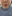 Lip filler (lip augmentation with HA) — Lollipop Plastic Surgery Clinic