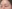 upper blepharoplasty (upper eyelid lift) — Oneul Plastic Surgery Clinic