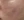 皮下分离术（Subcision，痘坑松解） — 术后 (30天) · The Ollim医美诊所