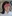 Lip lift (philtrum reduction) — Ondo Plastic Surgery