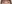 裏ハムラ法（経結膜的眼窩脂肪移動術） — ハッシュ美容外科クリニック