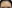 額縮小術（生え際下げ・ヘアライン下降術） — ヒート美容外科クリニック