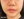 สลายไขมันใบหน้าด้วยเลเซอร์ (AccuSculpt) — ก่อนทำ (5วัน) · เออร์เน่คลินิก