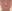 鼻尖形成術（自家軟骨移植） — コ・アン・ミ美容外科クリニック