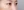 Insulated RF microneedle acne treatment (Agnes) — after (30days) · Remiel Plastic Surgery Clinic