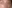 裏ハムラ法（経結膜的眼窩脂肪移動術） — エイペックス美容外科クリニック