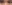 裏ハムラ法（経結膜的眼窩脂肪移動術） — ウィバース美容外科クリニック