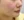 Belotero Revive (HA + glycerol skinbooster) — before (30days) · AB Plastic Surgery & Skin Clinic