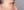 Insulated RF microneedle acne treatment (Agnes) — before (30days) · Remiel Plastic Surgery Clinic