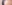 額縮小術（生え際下げ・ヘアライン下降術） — ザフィックス美容外科クリニック