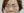 ฟิลเลอร์ใต้ตา (แก้ร่องใต้ตา / ขอบตาคล้ำ) — หลังทำ · ไอแบ็ค คลินิก