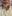 Double chin liposuction (submental liposuction) — Girin Plastic Surgery Clinic