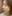 人中短縮（リップリフト） — ジャスト美容外科クリニック