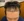 ปลูกผมบริเวณจอน — ก่อนทำ (180วัน) · แชอูดาคลินิก