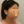 PRP自體脂肪移植（自體脂肪填補＋高濃度血小板血漿） — 術前 (42天) · The CL Clinic