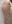 二の腕の脂肪溶解注射 — ロリポップ美容外科クリニック