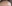 額（おでこ）の脂肪注入 — ファクト美容外科クリニック
