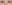 裏ハムラ法（経結膜的眼窩脂肪移動術） — プレジャー美容外科クリニック