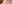 裏ハムラ法（経結膜的眼窩脂肪移動術） — ジャスト美容外科クリニック