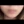 Full-face filler (full-face HA rejuvenation) — after · On Air Plastic Surgery Clinic