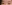 buried suture (non-incisional) double eyelid surgery — Seoul Eye Plastic Surgery Clinic