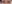 二重まぶた（自然癒着法） — チャイ美容外科