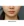 Volnewmer (โวลนิวเมอร์ ยกกระชับด้วย RF) — หลังทำ (90วัน) · คลินิกศัลยกรรมตกแต่งนาบี