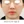 ウルセラプライム（Ultherapy PRIME） — 術前 · モンスタークリニック