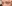 裏ハムラ法（経結膜的眼窩脂肪移動術） — ジャスト美容外科クリニック