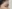 Brow lift — Urban Plastic Surgery Clinic