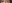buried suture (non-incisional) double eyelid surgery — 1mm Plastic Surgery
