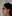 Forehead reduction (hairline lowering surgery) — Uri Plastic Surgery Clinic