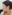 Full-face fat grafting (autologous fat transfer) — Mind Plastic Surgery