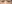 裏ハムラ法（経結膜的眼窩脂肪移動術） — プレジャー美容外科クリニック