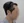 Hairline hair transplant (hairline lowering by grafting) — before (1days) · Vance Mosae Clinic